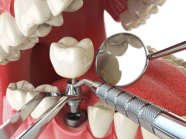 Best Emergency Root Canal Treatment in Clayton, CA